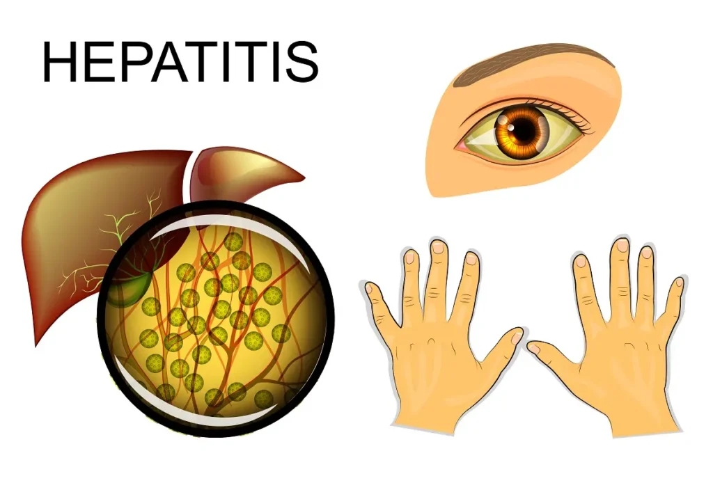 гепатит - симптоми