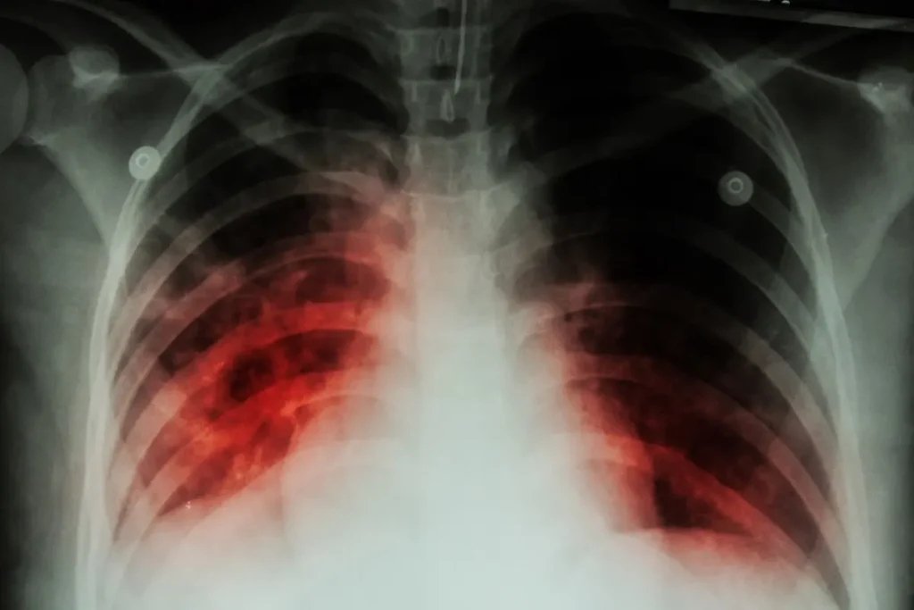 Симптоми та ознаки туберкульозу