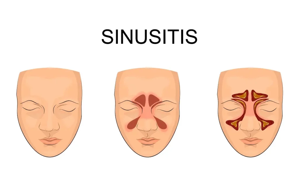 Синусит, гайморит - симптоми