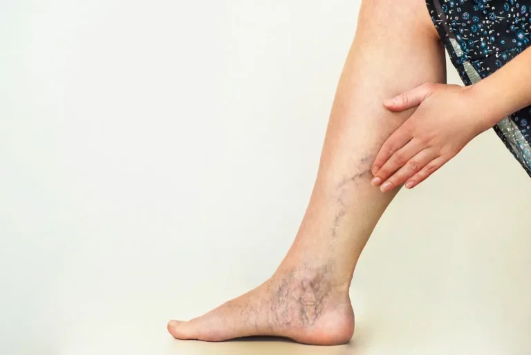 Варикоз на ногах: що це за хвороба і до чого призводить