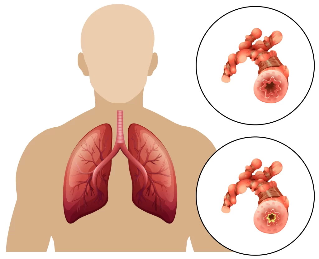 Як відбувається напад астми